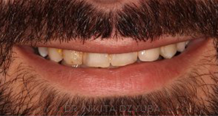 Before - Deansgate Dental Studio