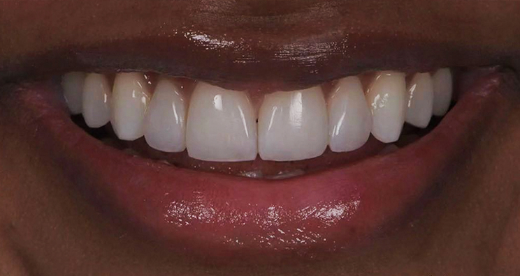 After - Deansgate Dental Studio